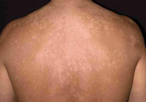 تظهر في الحر.. هذه أسباب الإصابة بالتينيا الملونة وطرق علاجها